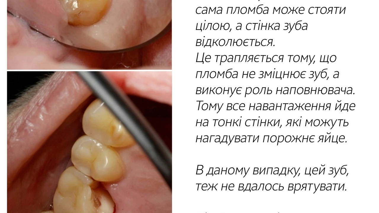Фотополімерна пломба: що це, як ставлять і скільки служить