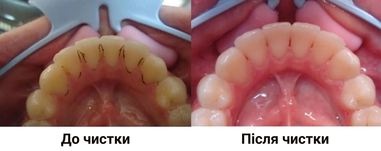 Що можна їсти після чищення зубів